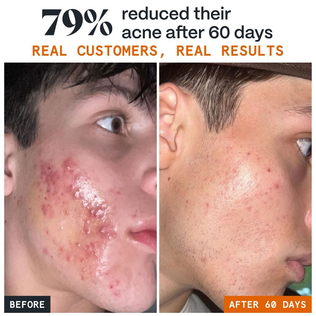 Pimple Stopper Night Balm
