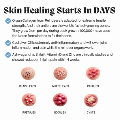 Complete Gut Repair & Hormonal Balance System for Male Acne