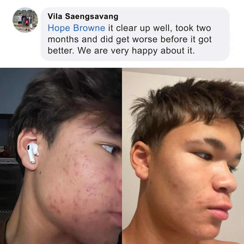 Pimple Scars Balm 2.0
